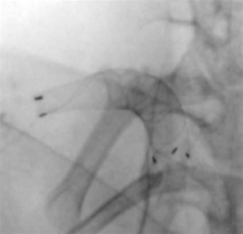 how to pronounce braided|Derivo Embolization Device for the Treatment of Intracranial Aneurysms.